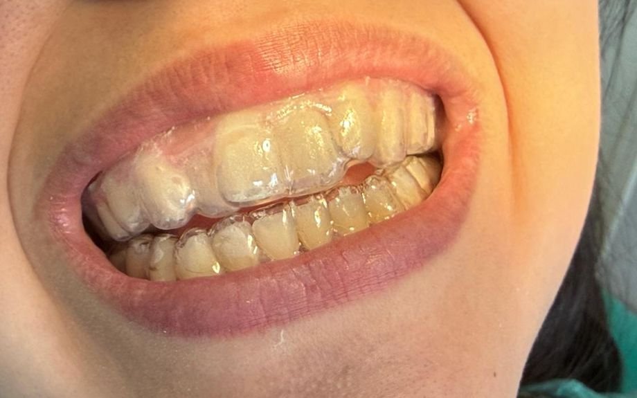 Alineador transparente colocado sobre los dientes